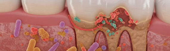 San Luis Obispo Gum Disease Treatment: Periodontal Care
